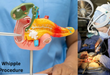 Whipple Procedure