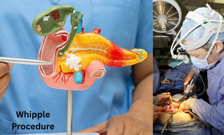 Whipple Procedure